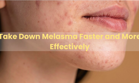 Cure Melasma